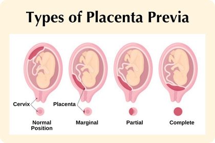Types placenta previa marginal, partial, complete