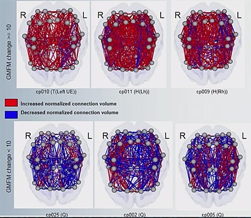 Cord Blood Treatment for Cerebral Palsy MRI Scans