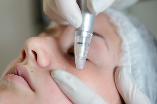 Microdermabrasion around the eyes