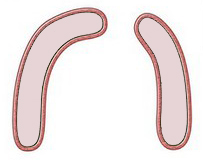 cleft in gum-line bone ridge