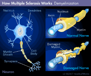 Stem Cells Making a Difference in Treating MS 