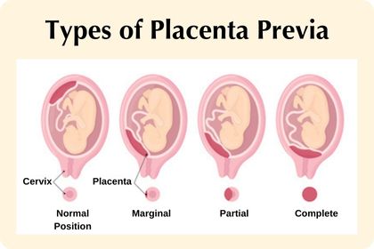 Placenta Previa: Types, Signs, and Risks