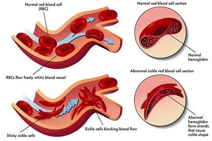 Exciting Advancements in Cord Blood Treatments for Sickle Cell Anemia