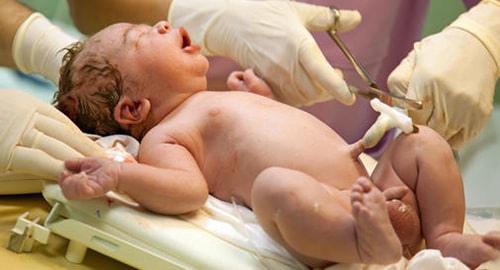 baby with umbilical cord being cut