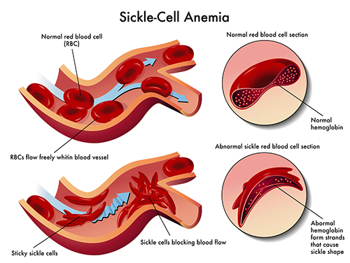 Sickle Cell Anemia blood cells