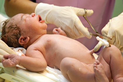 Delayed Cord Clamping & Cord Blood Banking Not Mutually Exclusive